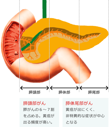 の すい臓 が 症状 ん